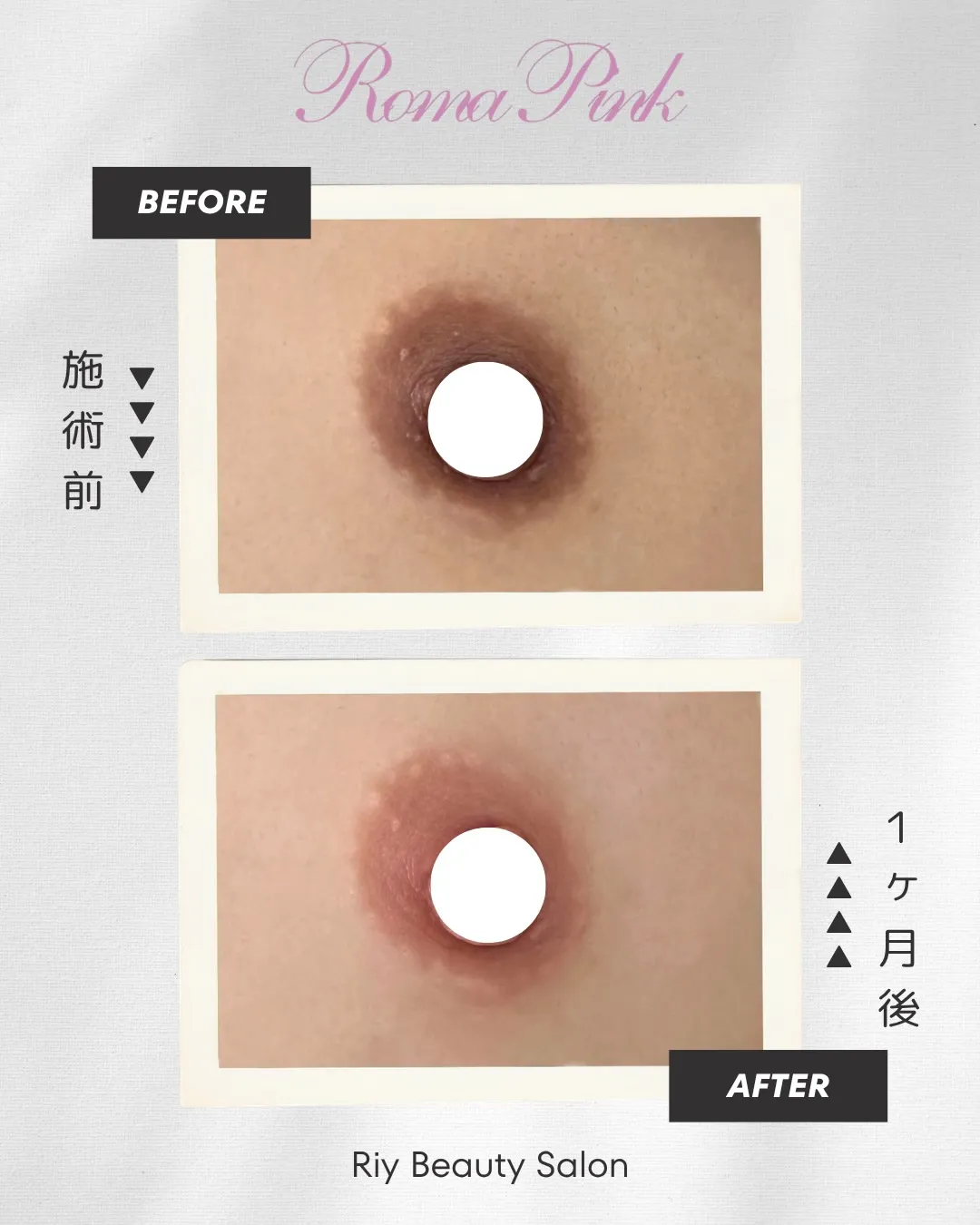 【 ローマピンク《バスト》1ヶ月後の変化👙 】